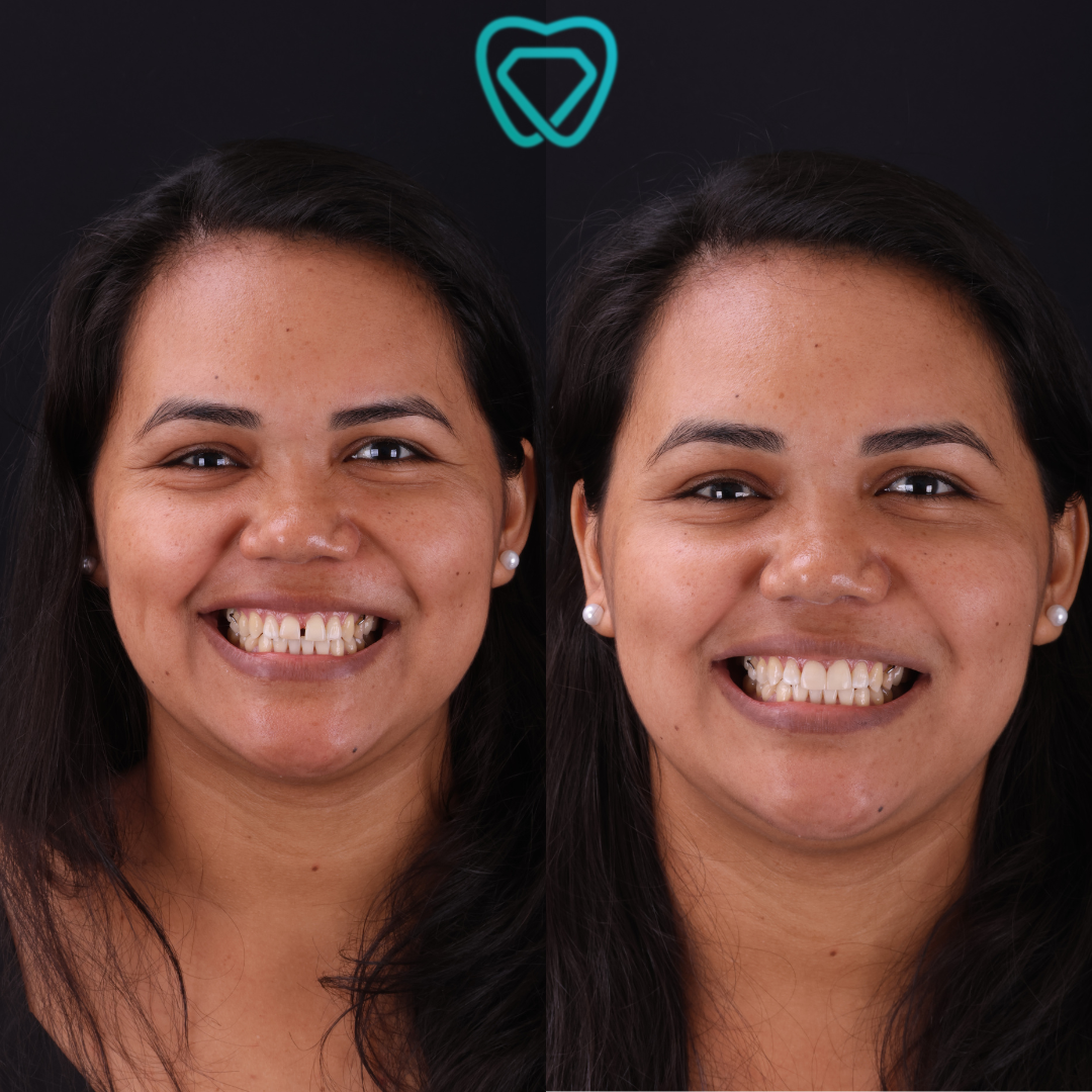 Antes e depois de tratamento odontológico, exemplo 1